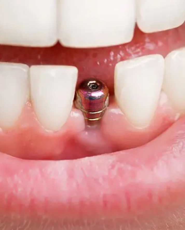 Implantaat in de mond voor plaatsing van implantaatkroon